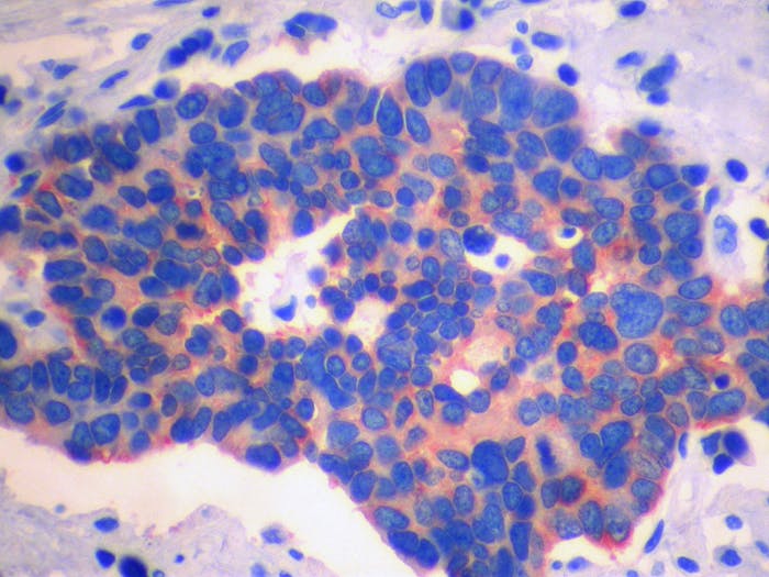 Small cell lung carcinoma, chromogranin immunostain