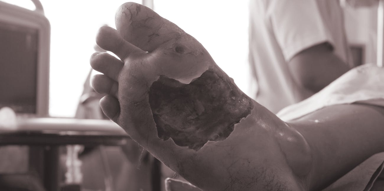 infected wound