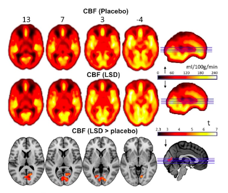 New Brain Images Show How Lsd Affects Our Minds Inverse