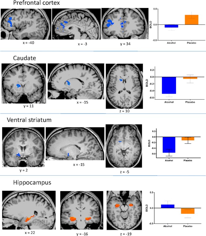 These scans show how alcohol-induced aggression was related to decreased activity in the prefrontal cortex, caudate, and ventral striatum, but increased activity in the hippocampus.