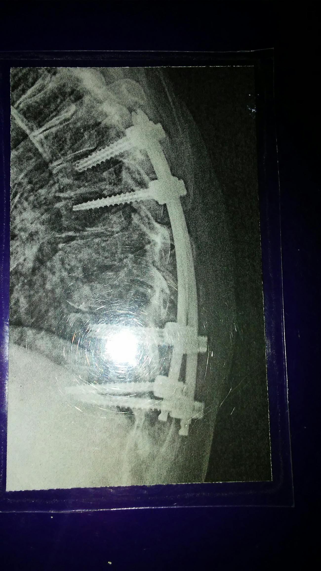 Teem had thoracic spinal fusion surgery, which required screws and rods to be placed in her back to steady her spine.