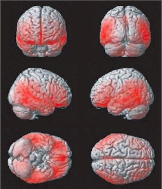 brain scans, teens