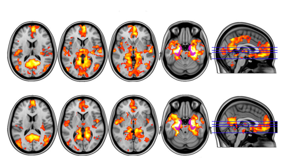 Magic Mushrooms Hit Brain's 'Reset' Button in Depressed Patients Inverse