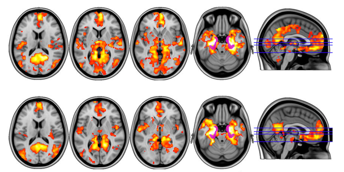 Magic Mushrooms Hit Brain's 'Reset' Button in Depressed Patients Inverse