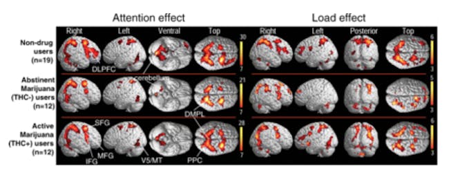 Statistical parametric maps of BOLD signals in abstinent marijuana users (THC−), active marijuana users (THC+) and non-drug user comparison subjects. Surface maps demonstrate the effect of attention (independent of load, left) and the effect of attentional load (increasing difficulty from tracking 2 to 3 to 4 balls, right) on repeated measures ANOVA (random-effects analyses) for each group. See Table 3 for P-values and T-scores for brain regions with attention effects, and Table 4 for regions with load effects. DLPFC: dorsal lateral prefrontal cortex; IFG: inferior frontal gyrus; MFG: middle frontal gyrus; SFG: superior frontal gyrus; PPC: posterior parietal cortices; DMPL: dorsomedial parietal lobule; MT/V5: motion detection area.