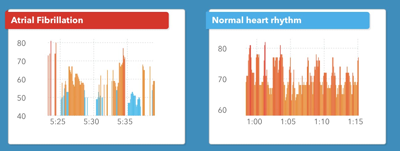 wearable heart disease detection