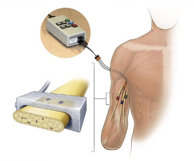 Electrical stimulation was delivered by an external stimulator (top left) through percutaneous leads to FINEs implanted on the median, ulnar, and radial nerves of an upper-limb amputee (bottom left). Each electrode contact evokes sensory percepts on small regions of the missing hand of the subject.