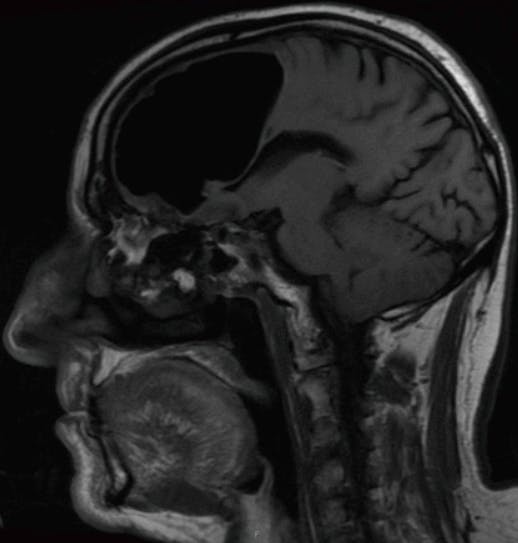 air pocket brain