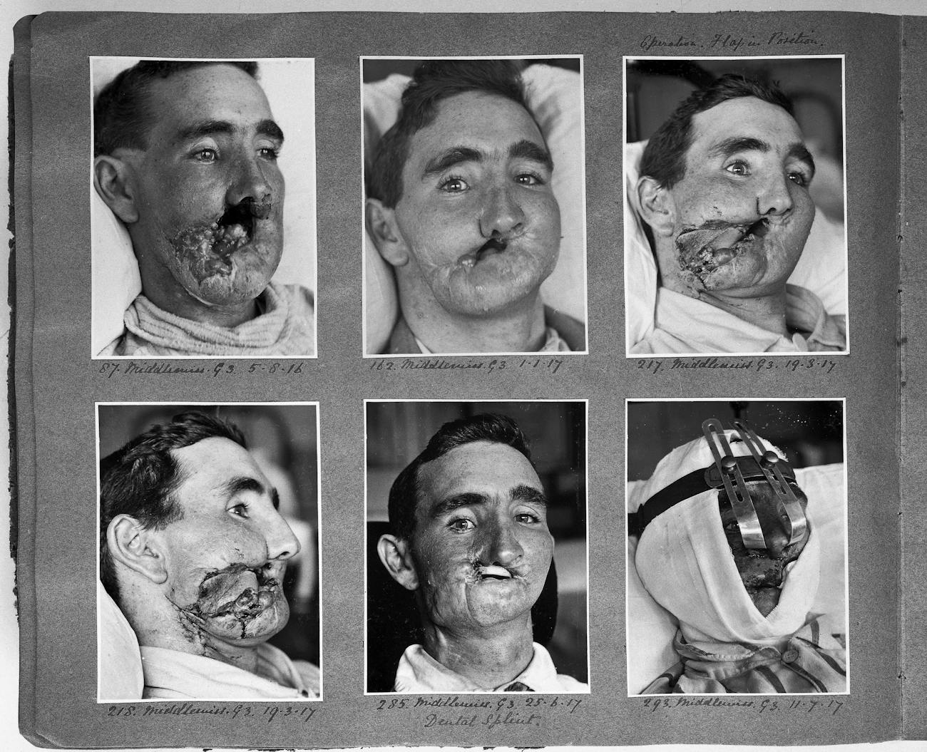 reconstructive surgery WWI