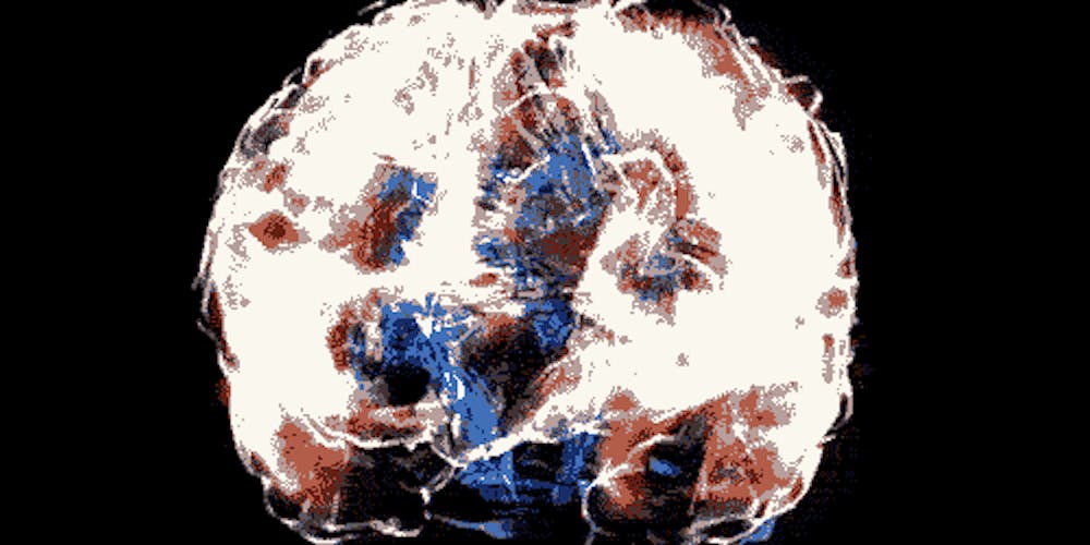 Transcranial direct stimulation coma