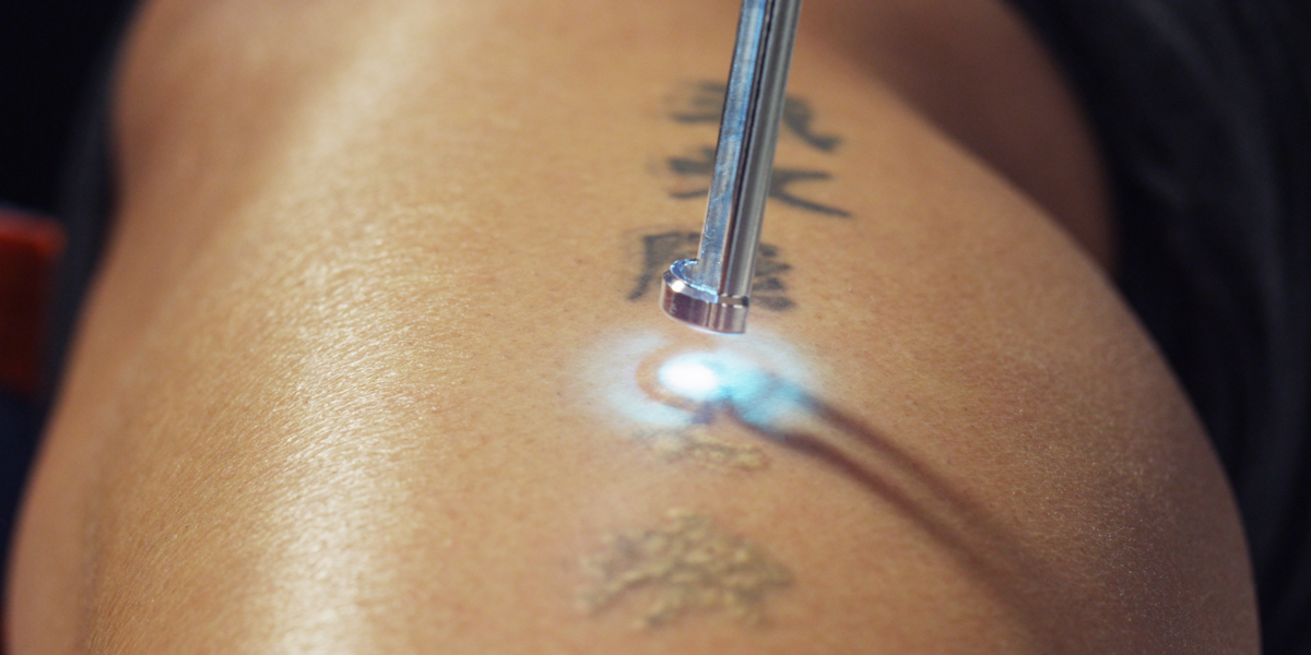 How Does Laser Tattoo Removal Work? It Hurts, But It's ...