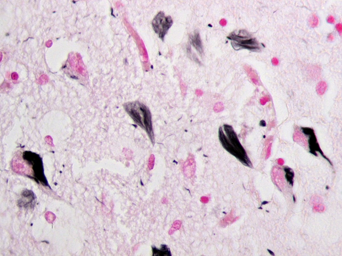 neurofibrillary tangles