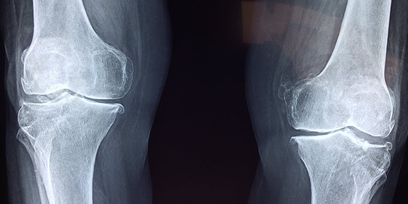 cartilage, x-ray
