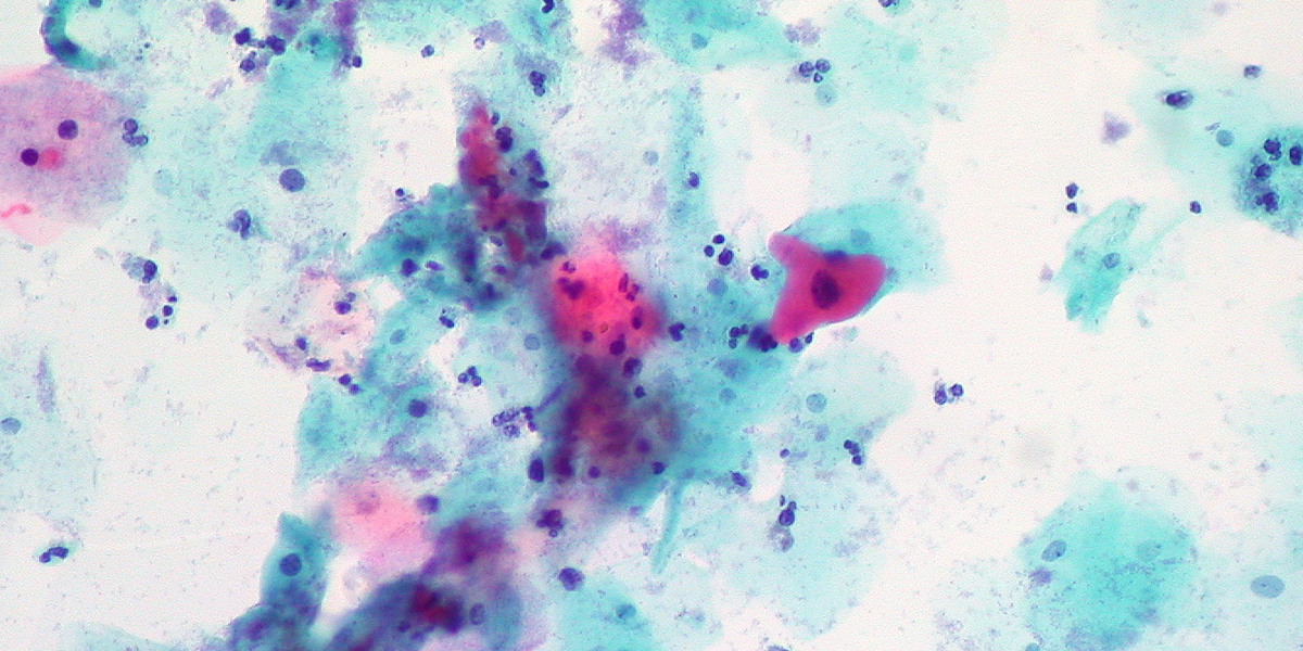 1 in 9 Men Now Have Oral HPV: What Does That Mean For You ...