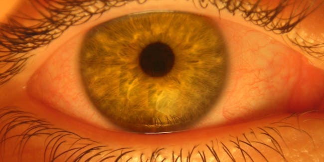Why Do Eyes Swell With Allergies? Redness and Itching is ...