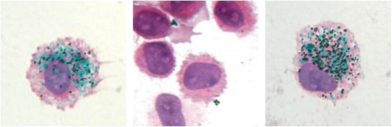 Macrophages encapsulate green tattoo ink pigment (left) and release it when the cells are killed (center). But 90 days later, new macrophages develop and swallow up the pigment again (right).