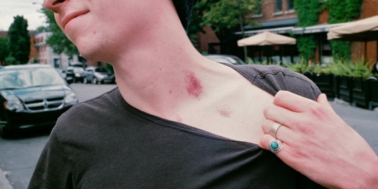 Science Explains How a Hickey Can Kill You Inverse