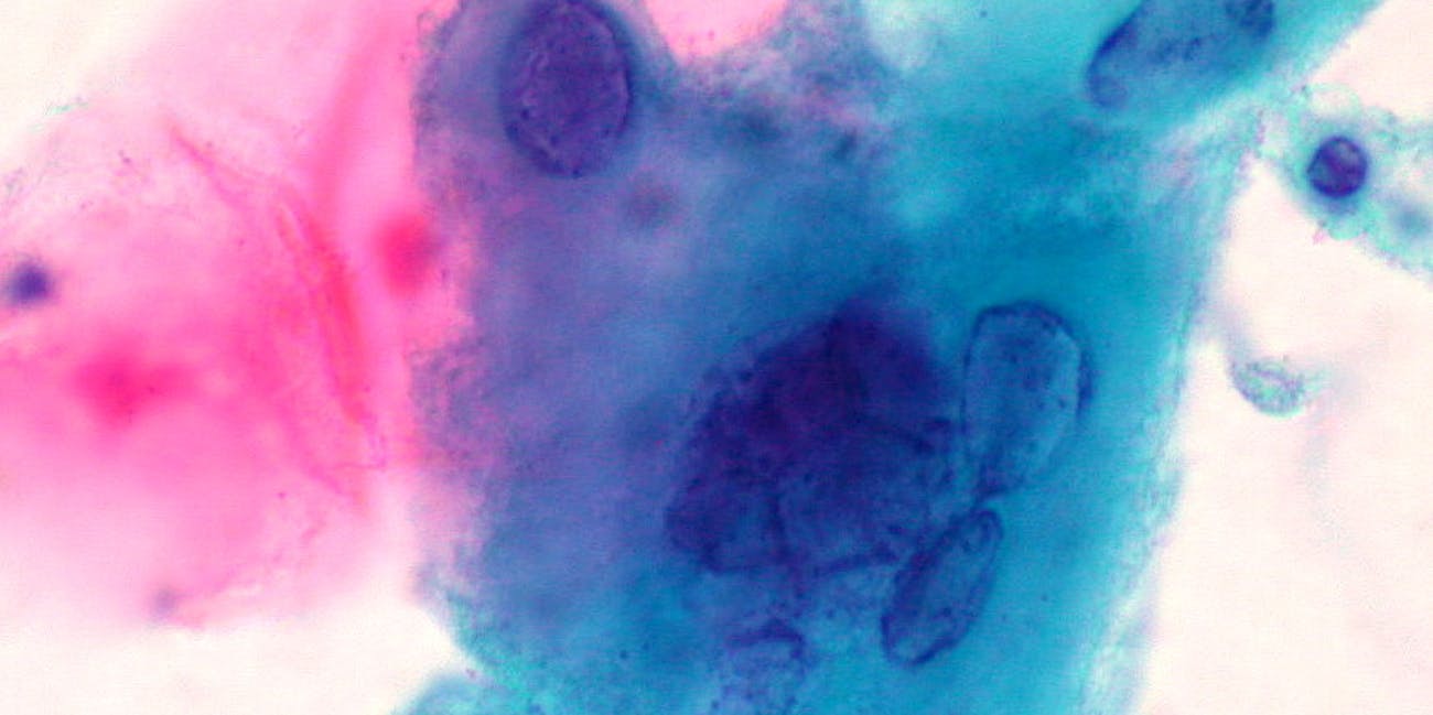 Herpes-infected squamous cells, ThinPrep