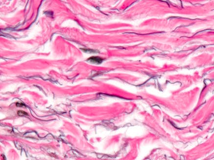 Collagen fibers support the fluid-filled channels that make up the interstitium.
