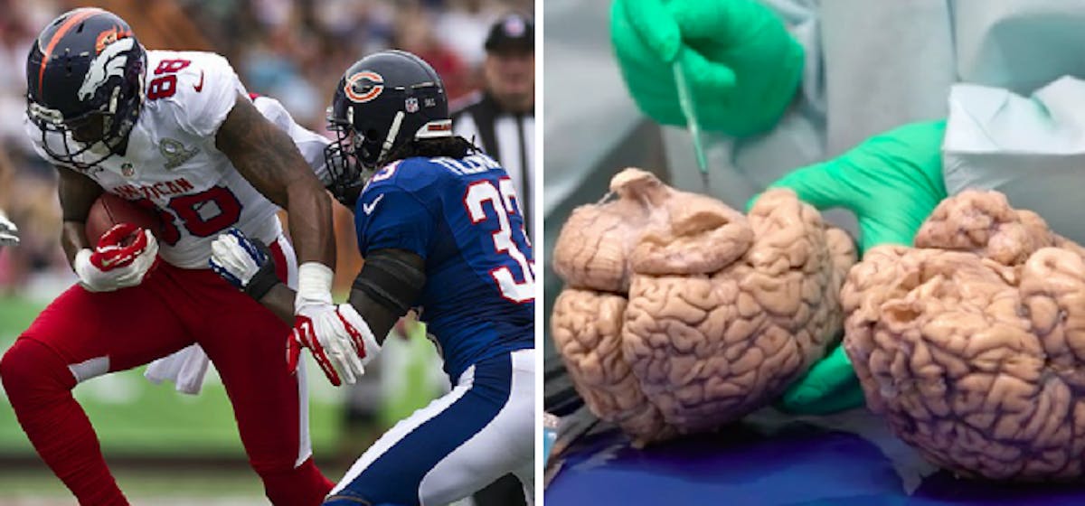 In New Study 99 Percent Of Ex Nfl Brains Show Evidence Of