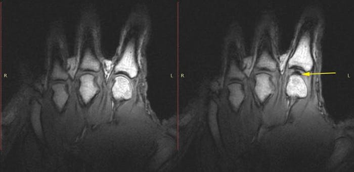 Before and after images of knuckles being cracked