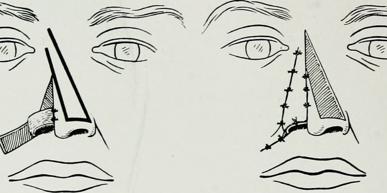 Rhinoplasty nose job surgery illustration body dysmorphia