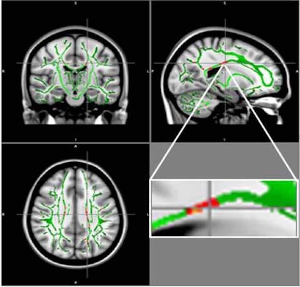 brain damage, teens, obesity
