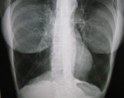 breast implant x-ray boobs