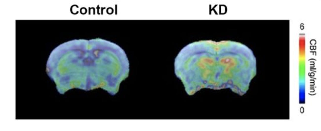 keto diet brain health aging