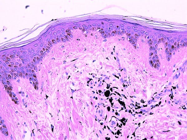 Tattoo microscope dermis