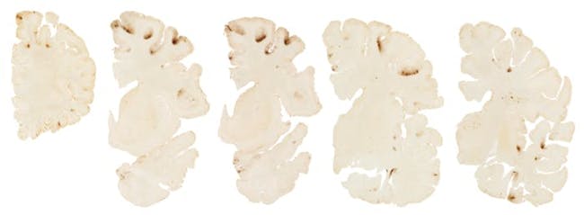 This graphic shows the classic features of CTE in the brain of Hernandez. He died by suicide in 2017 after convicted of a murder charge.