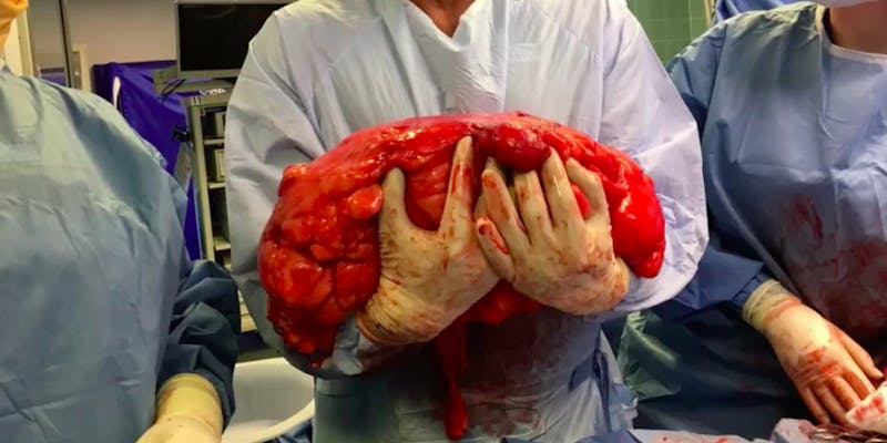 Man Assumed 30-Pound Tumor Removed from His Stomach Was Just a "Beer Belly"